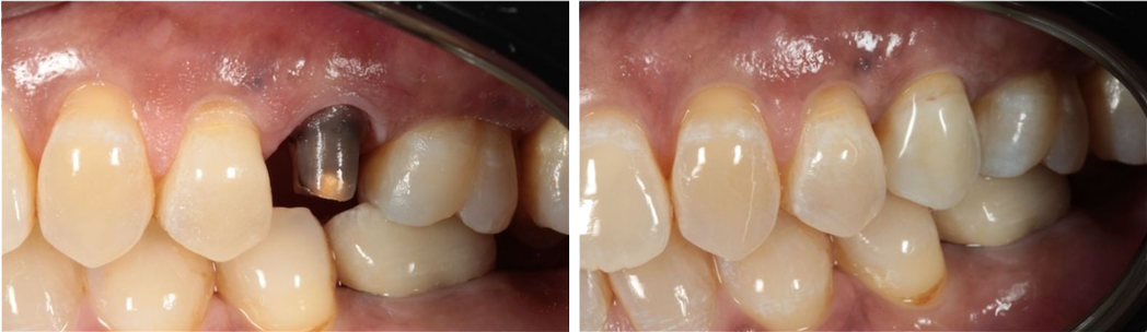dental implant solutions in sydenham