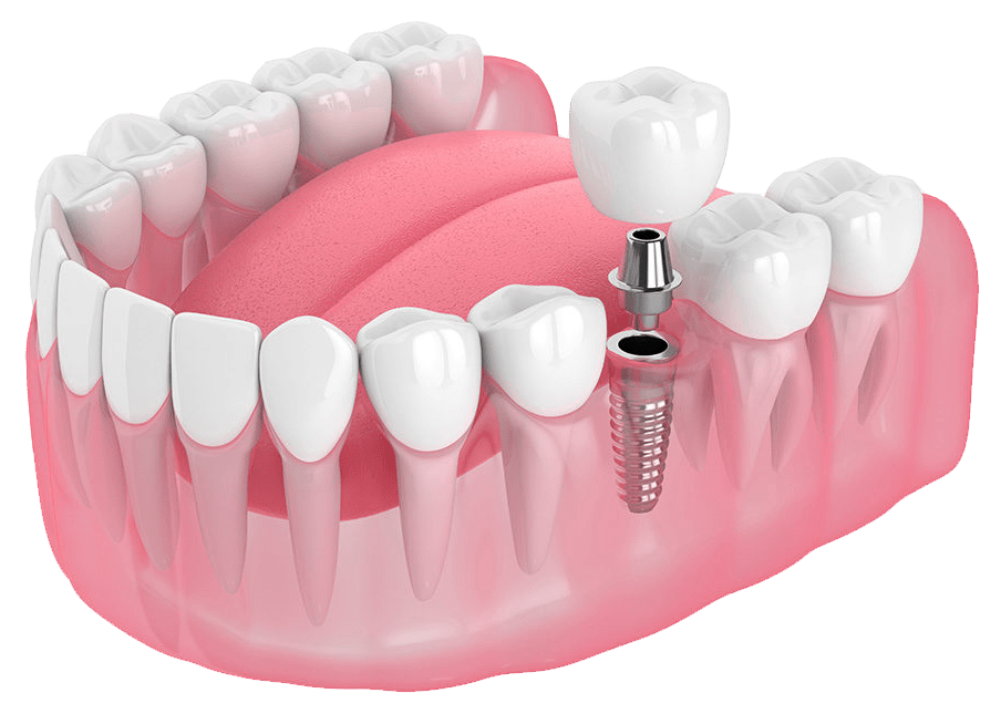 dental implants west norwood dental implant sydenham