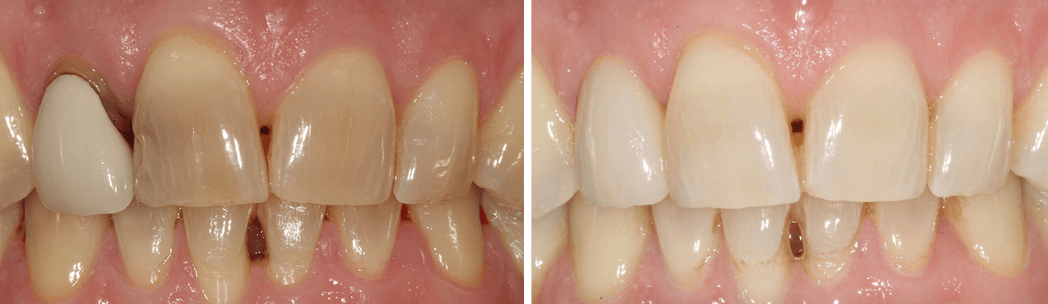 dental implant solutions in sydenham